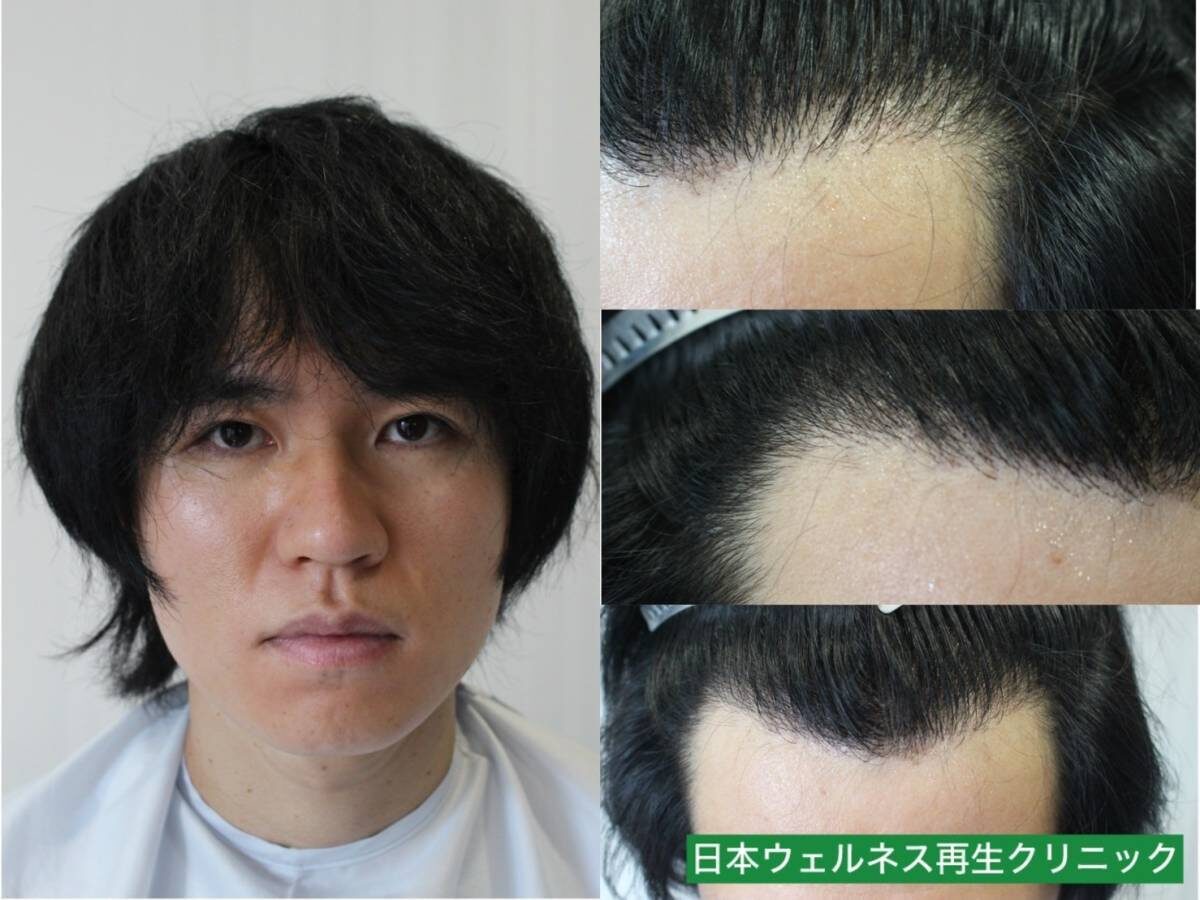 D・Kさん　30代男性【FUE】1100株