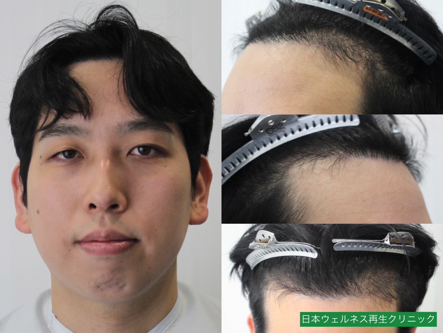K・Tさん　20代男性【FUE】1000株