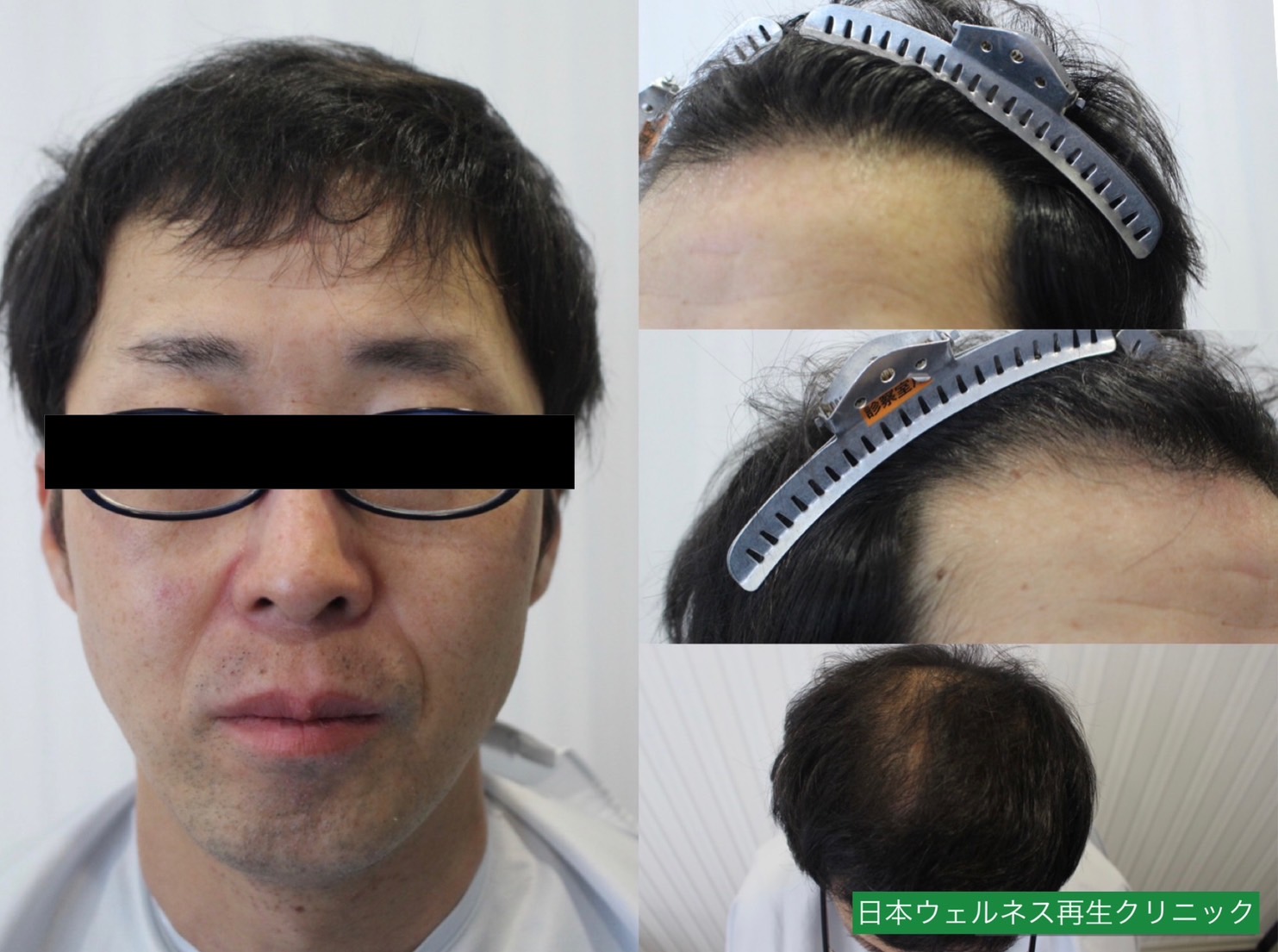 T・Uさん　40代男性【FUT】1500株