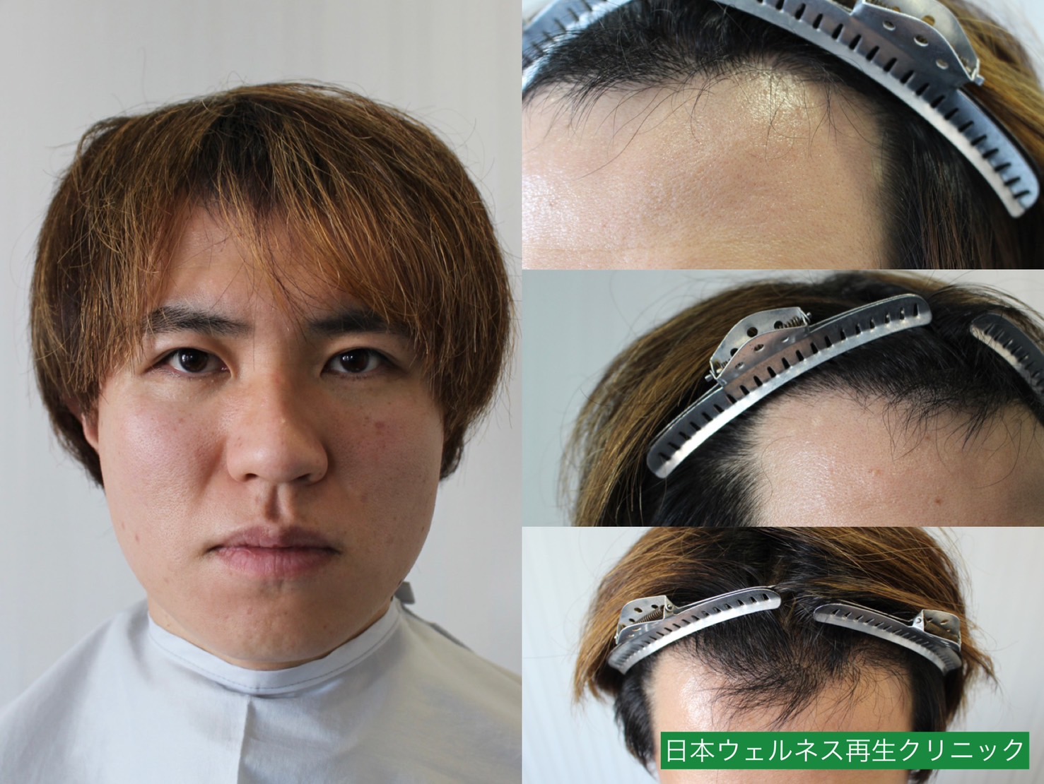 H・Iさん　30代男性【FUE】1100株