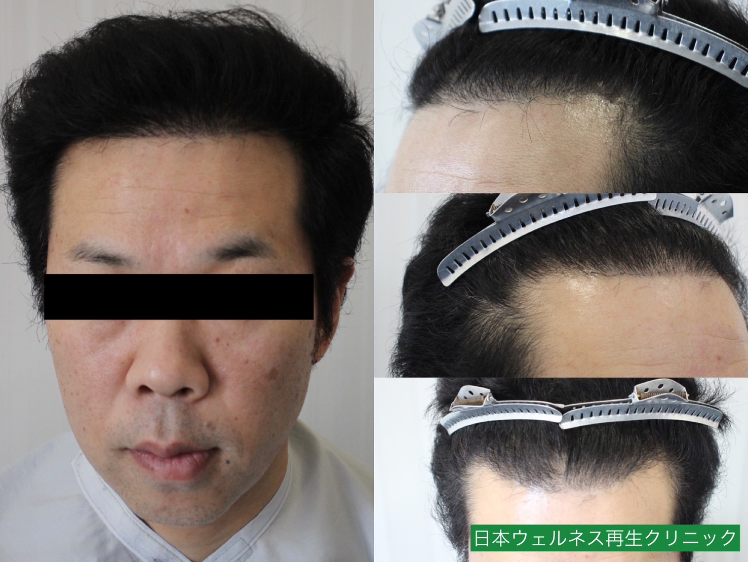 T・Oさん　40代男性【FUT】1300株