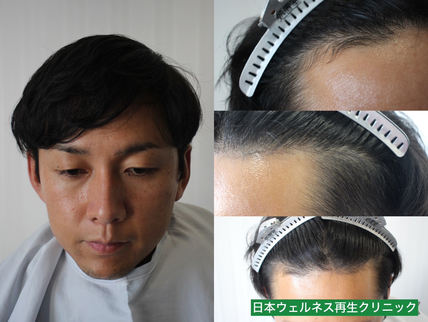 N・Nさん　30代男性【FUE】1300株
