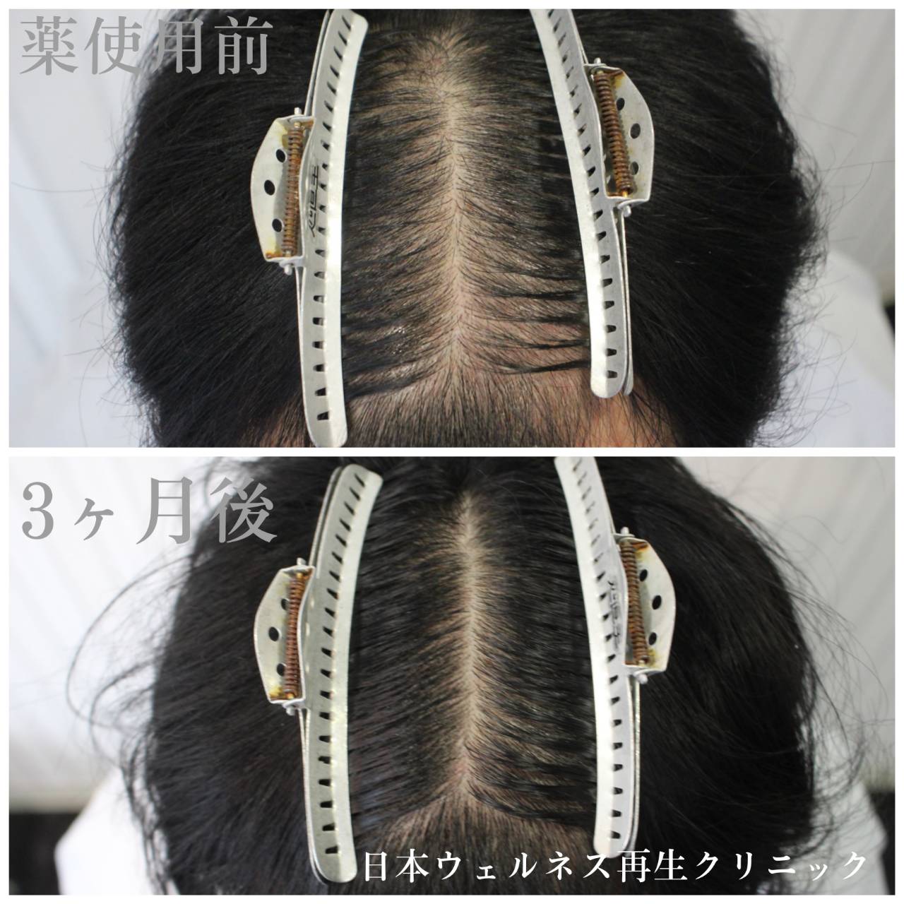AGA薬剤治療について
