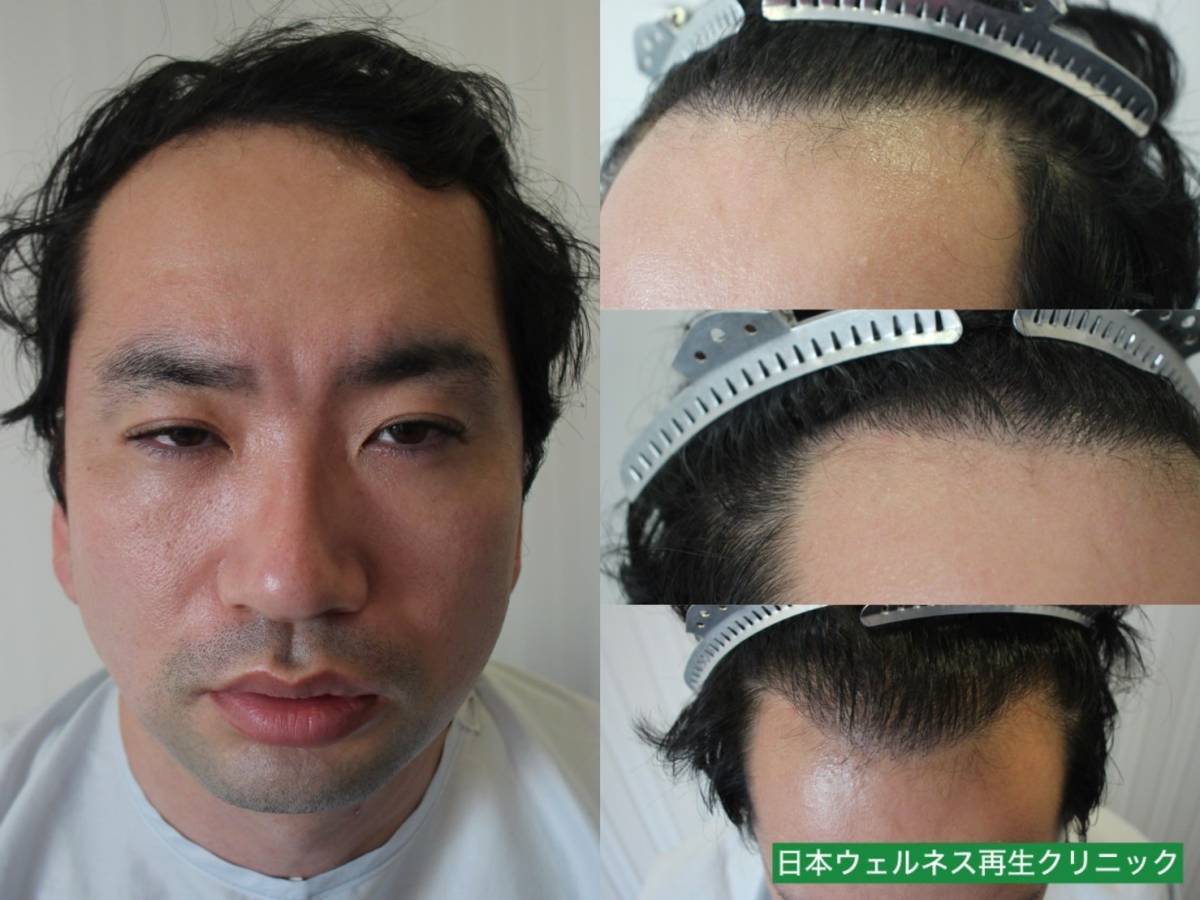 Y・Aさん　30代男性　【FUT】1500株